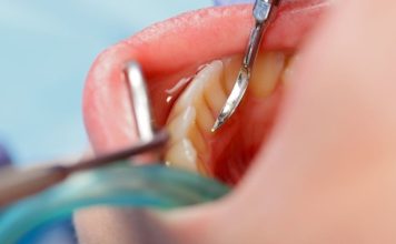 יישור שיניים וציפוי זירקוניה: הדרך לאסתטיקה מושלמת